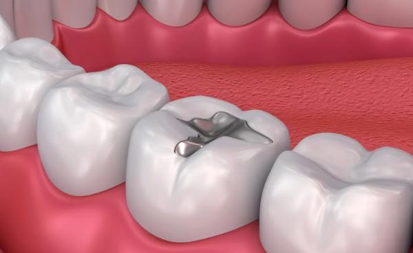 L'Unione Europea vieta definitivamente l'uso di amalgama dentale dal 2025